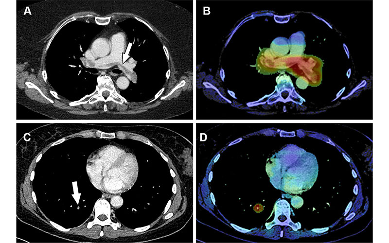 True-positive detection of incidental pulmonary embolism (PE) by the artificial intelligence (AI) software. Topff fig 2 22-0163