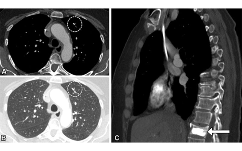 Рис. 5. Радиографика Юна и др. Слепота невнимания и ошибка слепого пятна при интерпретации результатов визуализации у 72-летней женщины с анамнезом рака яичников и бывшим курением, которая испытывала одышку при физической нагрузке.