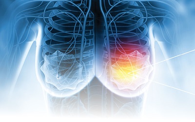 Breast imaging and AI concept showing abstract depiction of breast lesion