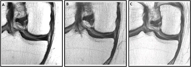 Knee MRI scans in a 57-7ear-old male participant in the Osteoarthritis Initiative who was administered a hyaluronic acid injection.