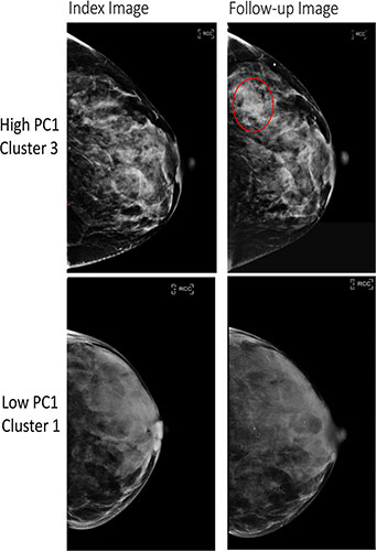 Full-field digital mammography (FFDM) images in a 52-year-old woman show a high-risk phenotype, and FFDM images in a 58-year-old woman show a low-risk phenotype.