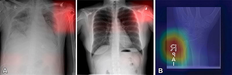 Images from a deep learning (DL) model in radiology that can learn to identify confounding features related to bias and unfair predictions.