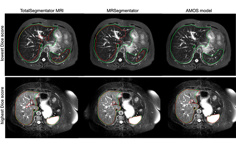 Axial MRI images from the cases with the lowest (top) and highest (bottom) Dice score in the CHAOS external test set for our proposed model, TotalSegmentator MRI, as well as for two publicly available baseline models.