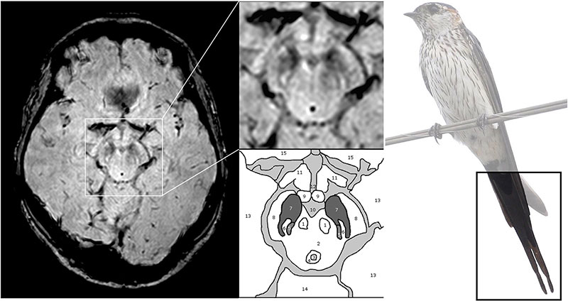 High-spatial-resolution susceptibility-weighted imaging of a normal nigrosome 1 (N1). 
