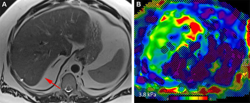 Role of MR elastography in assessing eligibility for resmetirom treatment of at-risk MASH patients.