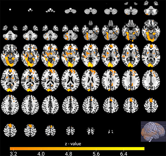 Functional MRI (blood oxygenation level–dependent) maps show brain activity of football fans.