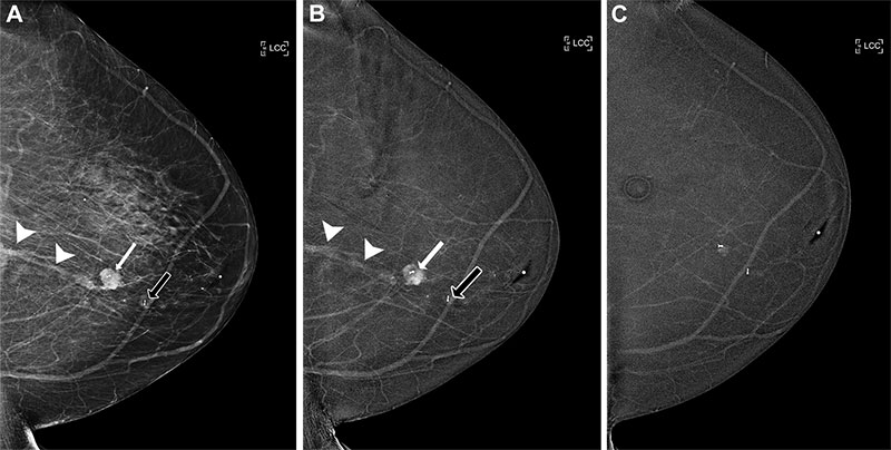 Evaluation of extent of disease at CEM in an 80-year-old woman.