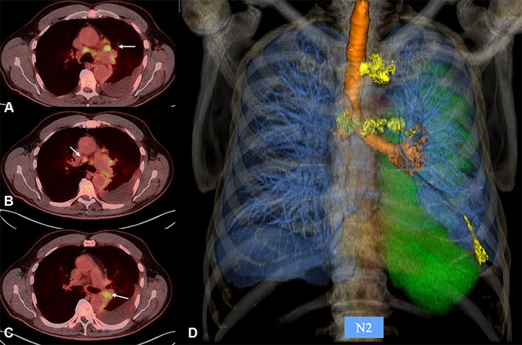 Images in a 66-year-old male patient with left-sided pleural mesothelioma (clinical T1) and N2 with contralateral mediastinal fluorodeoxyglucose-avid nodes at PET/CT.