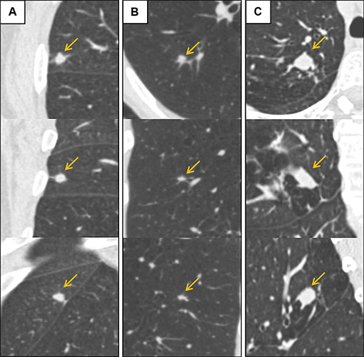 Low-dose CT images show examples of screen-detected pulmonary nodules