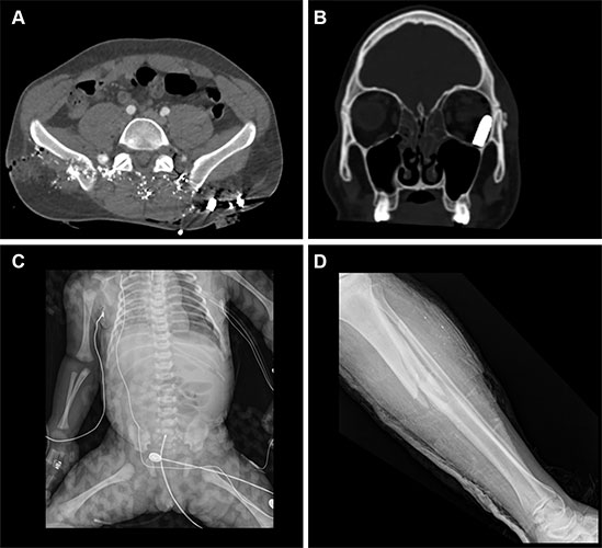 Axial CT scan at pelvic level of a 34-year-old male patient showing multiple shrapnel fragments in the pelvis.