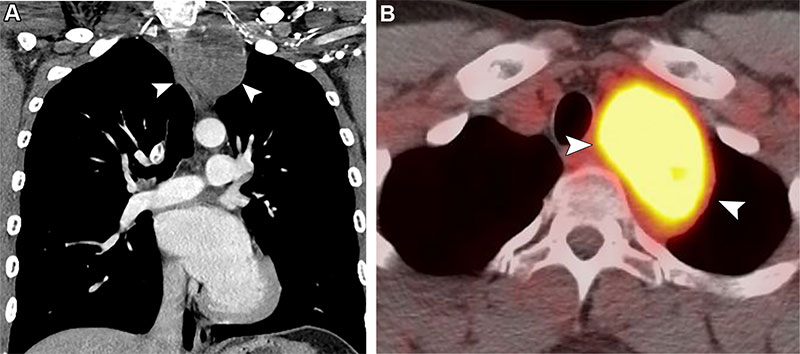 Post-RT malignancy in a 27-year-old man with a history of treated Hodgkin lymphoma and RT 12 years earlier.