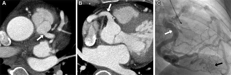 Anomalous left coronary artery from the pulmonary artery in a 50-year-old woman who presented to the emergency department with chest pain.