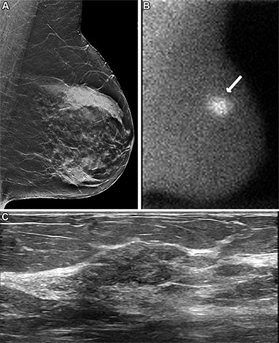 Images in a 57-year-old woman who presented for breast cancer screening
