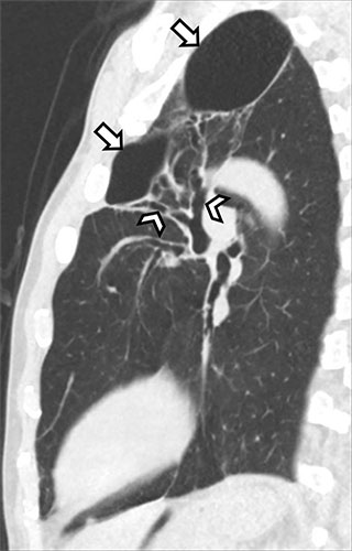 Sagittal noncontrast CT image in a 60-year-old man with a history of daily marijuana use but no reported cigarette smoking.