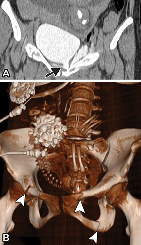 Extraperitoneal bladder rupture in a 24-year-old woman at 29 weeks of gestation after experiencing trauma.