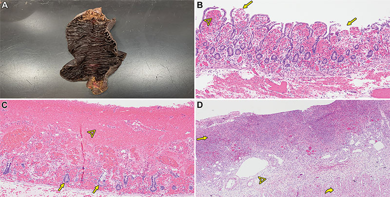 Gross and microscopic (histologic) examples of ischemic bowel disease.