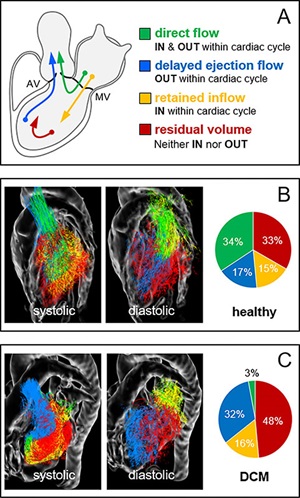 Four-dimensional flow MRI–derived left ventricular flow components.