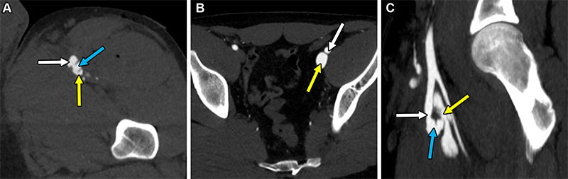 Axial arterial phase CT image of arteriovenous fistula resulting from a gunshot injury in a 27-year-old man.