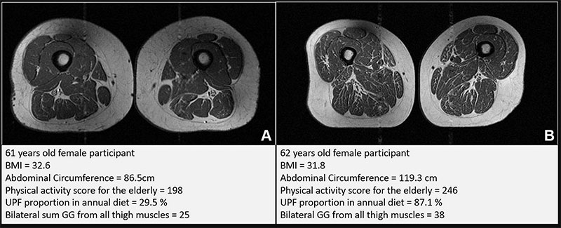 Representative axial T1-weighted spin-echo thigh MRI scans.