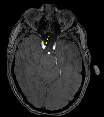 Representative axial time-of-flight MR angiography image shows a medially projecting intracranial aneurysm originating from the right cavernous segment of the internal carotid artery.