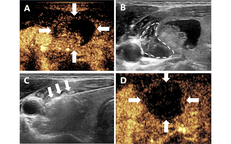 Radiology: Artificial Intelligence 240431 Fig 2 US images in a 47-year-old woman with a benign thyroid nodule in the right lobe of the thyroid gland who underwent microwave ablation. 