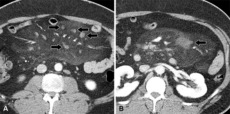 Axial portal venous phase CECT images show misty mesentery with multiple prominent nonenlarged lymph nodes.