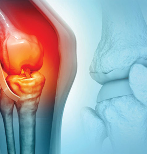 Illustration of a knee joint with highlighted pain and inflammation.