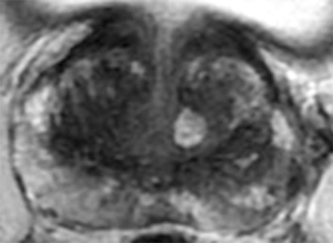 PRECISE 5 prostate cancer in a man with a PSA level of 4.1 ng/mL. 