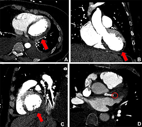 CT scans of 70-year-old female patient showing large perfusion defect in myocardium.