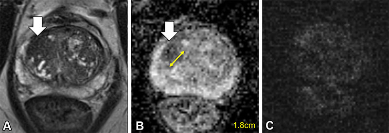 Zial T2-weighted images of a prostate lesion in a 57-year-old man (PSA level, 8.6 ng/mL; PSA density, 0.13 ng/mL/cm3). 