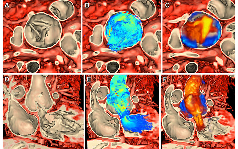 Integrated rendering of myocardial tissue and flow vectors from ferumoxytol-enhanced four-dimensional flow acquisition from cardiac MRI in a 5-year-old female patient with neoaortic insufficiency.
