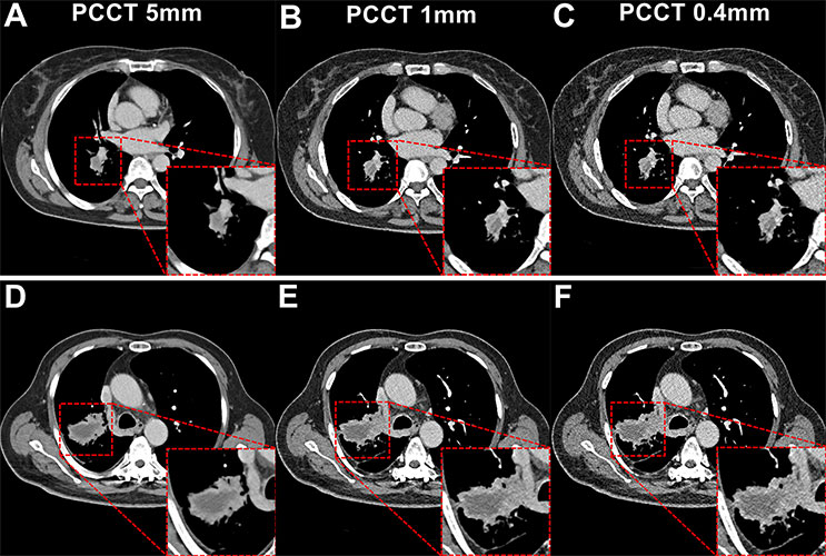Subgroup analysis based on lesion size on photon-counting CT images. 