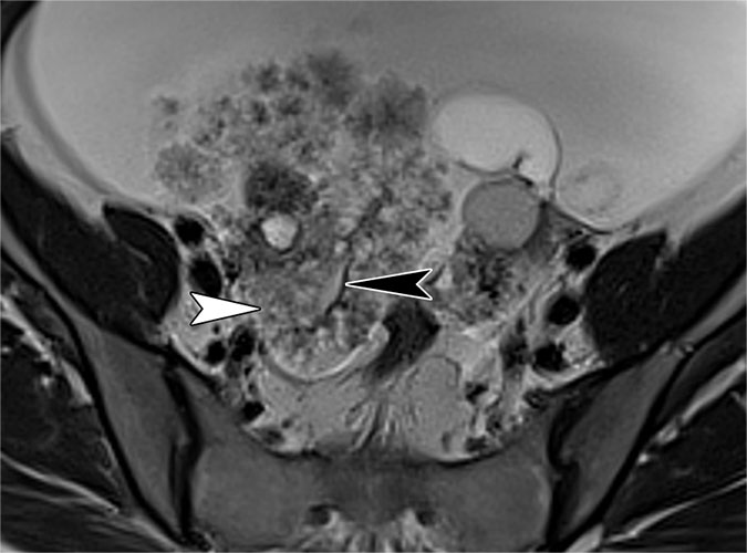 Bilateral serous borderline tumors in a 41-year-old female patient presenting with pelvic pain, bloating, and elevated serum CA-125 levels. 