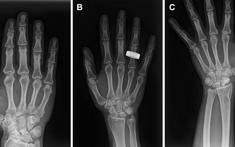Representative preflight, in-flight, and postflight hand radiographs.
