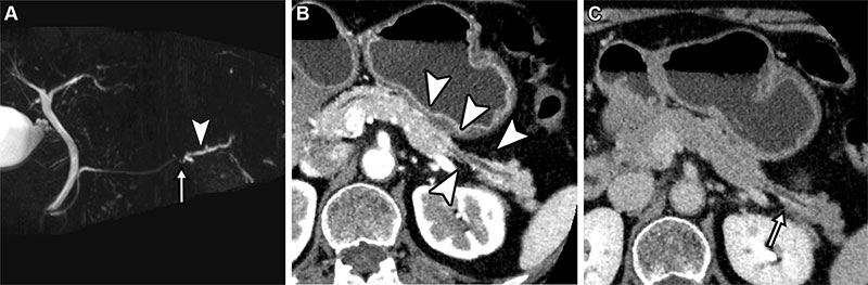 High-grade pancreatic intraepithelial neoplasia (PanIN) in a 73-year-old woman.