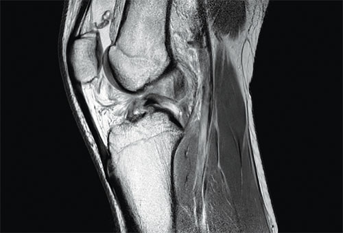 MRI image of a knee
