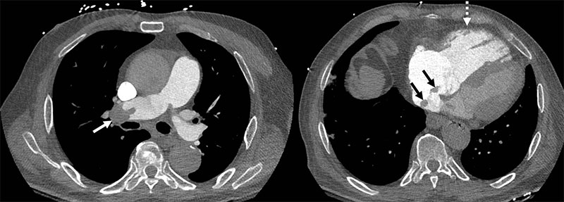 Acute pulmonary embolism (PE) with right ventricle (RV) enlargement and clot-in-transit. 