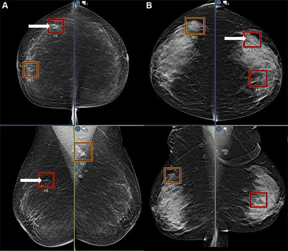 Example mammograms from ProFound Pro 2.x (DeepHealth) output show localized intermediate- (orange) and high- (red) suspicion bounding boxes in craniocaudal and mediolateral oblique views. 