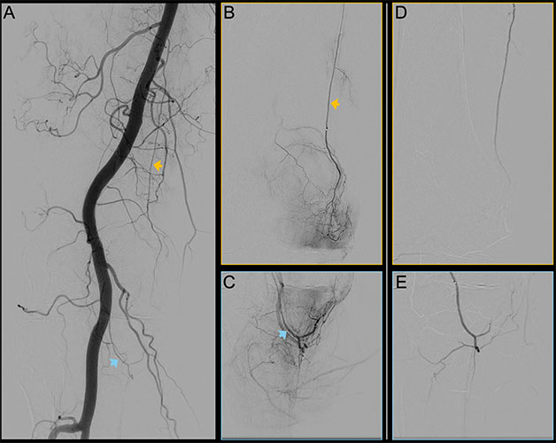 Digital subtraction angiography images of the right knee joint of a 62-year-old participant with predominantly medial knee osteoarthritis (OA).