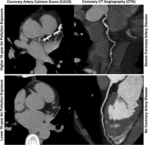 Axial images from unenhanced calcium score cardiac CT (left) and curved planar reformation images from CT angiography (right) show that higher long-term exposure to air pollution is associated with greater coronary artery calcium and more obstructive coronary artery disease (CAD). 