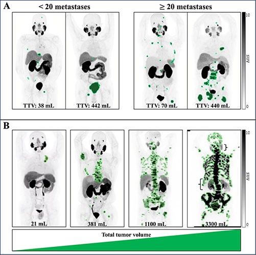 Prostate-specific membrane antigen PET images