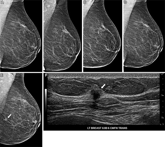 Images in a 75-year-old woman who underwent routine screening mammography in 2022. 