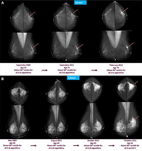Screening mammograms and AI score changes over time in two individuals with screen-detected cancer. Full-field digital mammograms show craniocaudal (top) and mediolateral (bottom) views of the left and right breast.