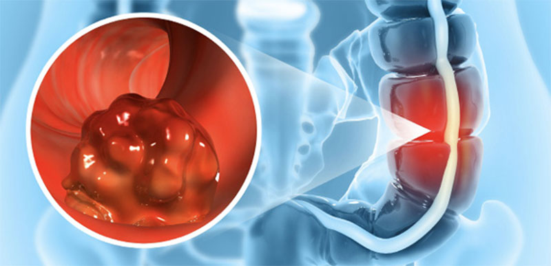 Stylized image of colorectal cancer.