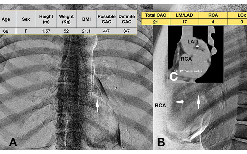 Mild coronary artery calcium (CAC) best illustrated on the frontal image: 66-year-old female. PA and lateral DE high Z images. RYCT 240255