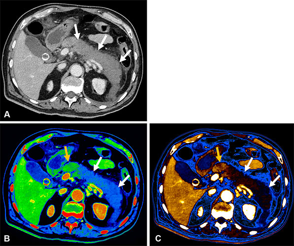 Acute pancreatitis in a 54-year-old man with intense epigastric pain of less than 24 hours.