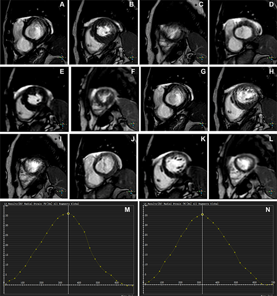 Representative MR images of participants with difficulty with breath holding and arrhythmia. Zhang et al RYCTI 250298
