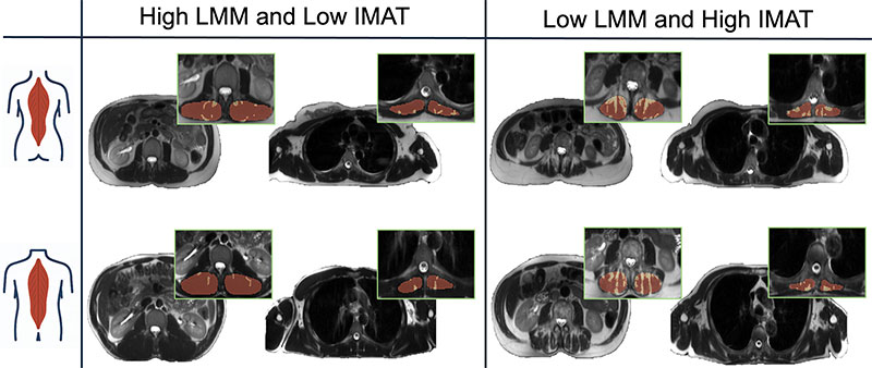 Exemplary cases across four intermuscular adipose tissue (IMAT)–lean muscle mass (LMM) z score combinations. The figure shows four LMM-IMAT combinations in women (top row) and men (bottom row). 