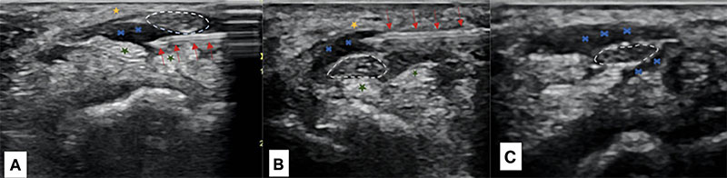 Series of ultrasound images showing hydrodissection treatment for carpal tunnel syndrome. A needle is positioned above and below the median nerve to inject fluid and separate the nerve from surrounding tissues. The final image shows the nerve surrounded by fluid after treatment.