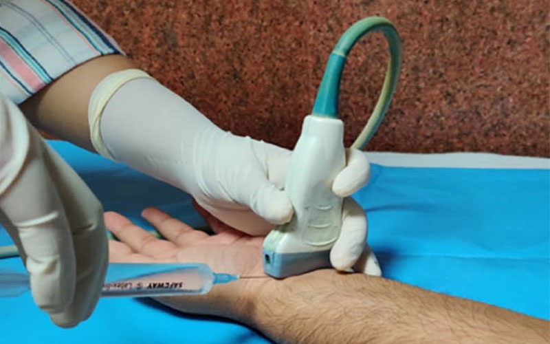 Photograph depicts the in-plane technique of needle insertion for the US-guided hydrodissection procedure using the radial approach in left wrist CTS.